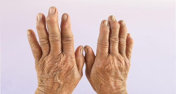 arthrose des doigts