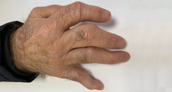 L’arthrose des doigts